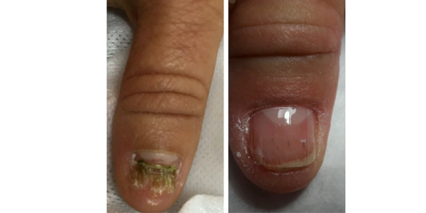 Nail Revive Solution