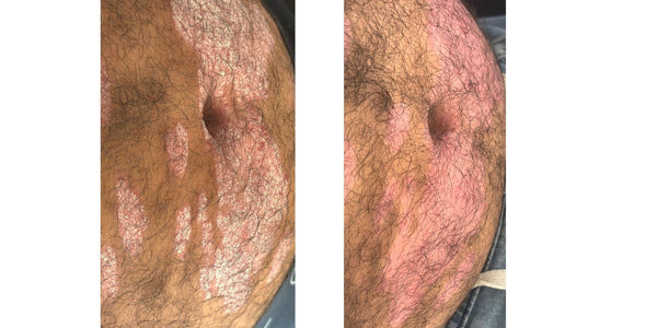 Unfung Skin Solution
